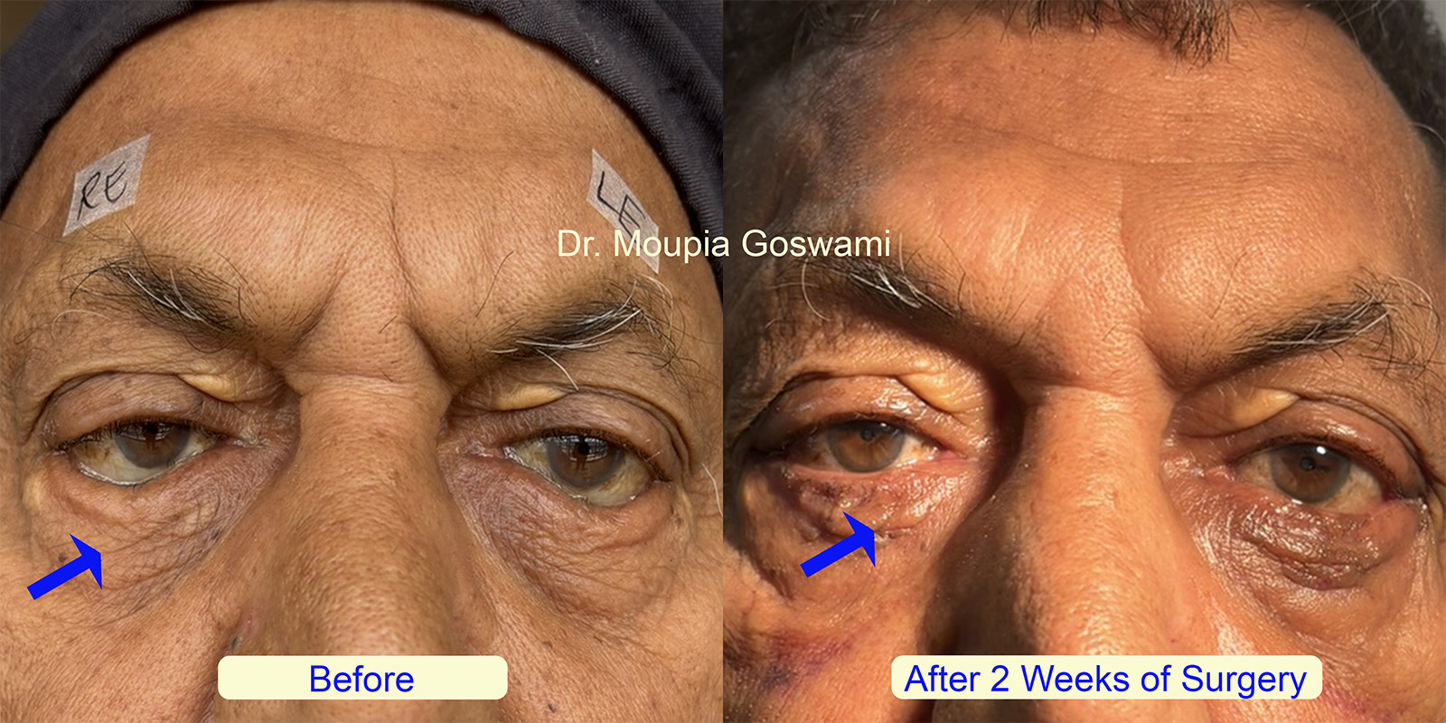 Entropion Surgery Before and After - Case 3